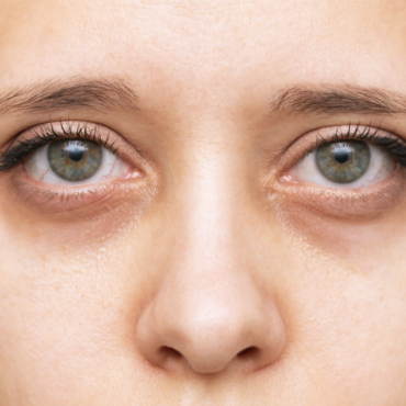 Как убрать синяки под глазами в домашних условиях?