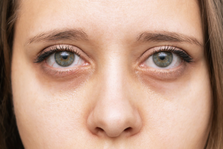 Как убрать синяки под глазами в домашних условиях?